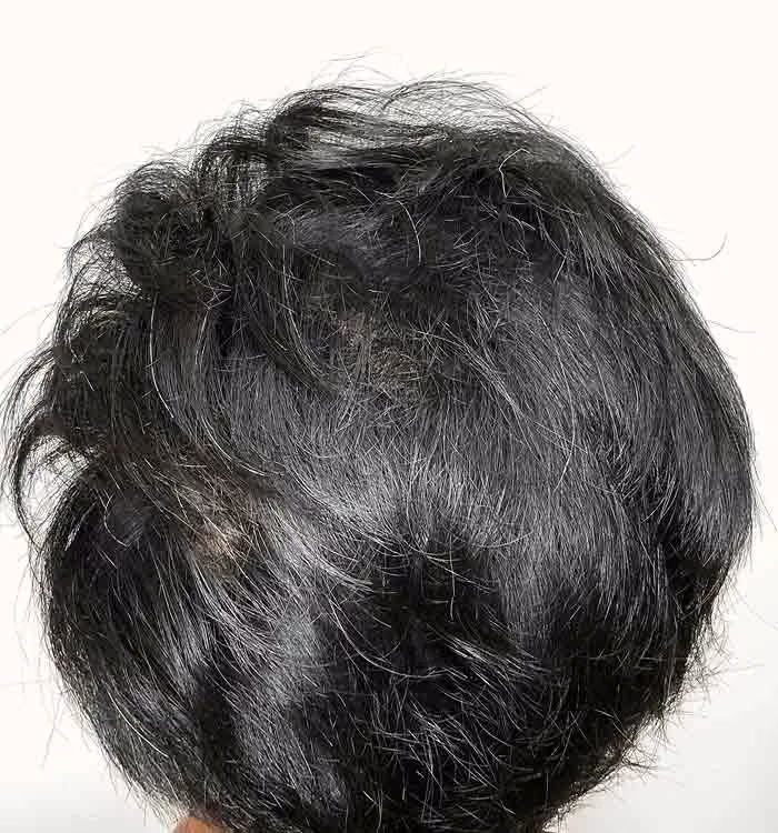 Nachher: Mann, 34 Jahre, Hinterkopf nach der regenerativen Haartherapie