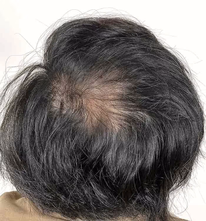 Vorher: Mann, 34 Jahre, Hinterkopf vor der regenerativen Haartherapie