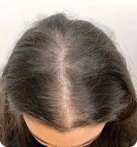 Vorher: Frau, 25 Jahre, Scheitel vor der regenerativen Haartherapie