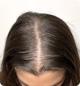 Nachher: Frau, 25 Jahre, Scheitel nach der regenerativen Haartherapie