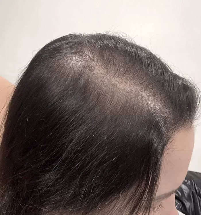 Nachher: Frau, 32 Jahre, Scheitel nach der regenerativen Haartherapie