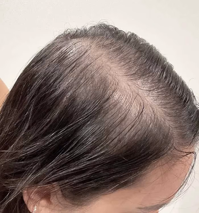 Vorher: Frau, 32 Jahre, Scheitel vor der regenerativen Haartherapie