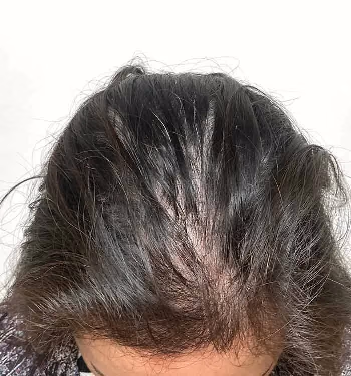 Nachher: Frau, 37 Jahre, Scheitel nach der regenerativen Haartherapie