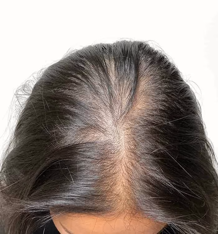 Vorher: Frau, 37 Jahre, Scheitel vor der regenerativen Haartherapie