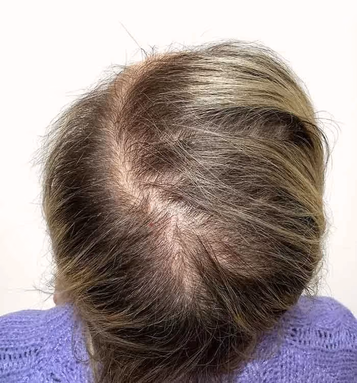 Vorher: Frau, 44 Jahre, Diffuse Ausdünnung vor der regenerativen Haartherapie
