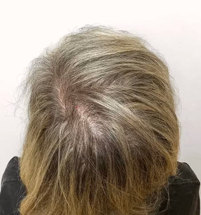 Nachher: Frau, 44 Jahre, Diffuse Ausdünnung nach der regenerativen Haartherapie