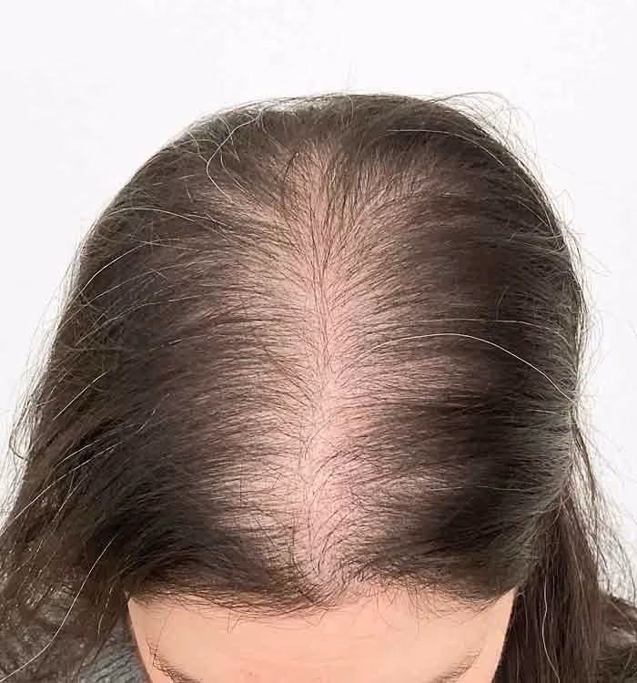 Vorher: Frau, 35 Jahre, Scheitel vor der regenerativen Haartherapie