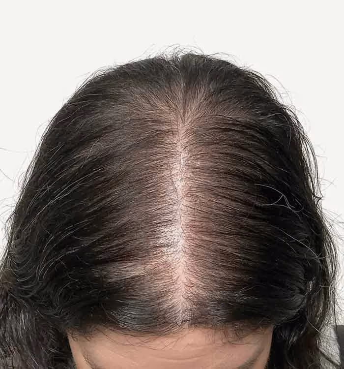 Nachher: Frau, 35 Jahre, Scheitel nach der regenerativen Haartherapie