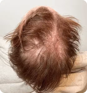 Vorher: Frau, 52 Jahre, Diffuse Ausdünnung vor der regenerativen Haartherapie