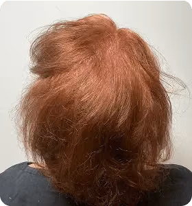Nachher: Frau, 52 Jahre, Diffuse Ausdünnung nach der regenerativen Haartherapie