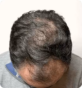 Nachher: Mann, 37 Jahre, Hinterkopf nach der regenerativen Haartherapie