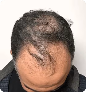 Vorher: Mann, 37 Jahre, Hinterkopf vor der regenerativen Haartherapie