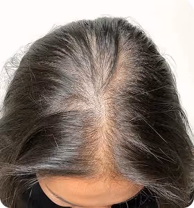 Vorher: Frau, 31 Jahre, Scheitel vor der regenerativen Haartherapie