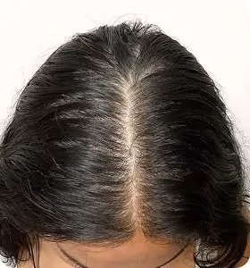 Nachher: Frau, 31 Jahre, Scheitel nach der regenerativen Haartherapie