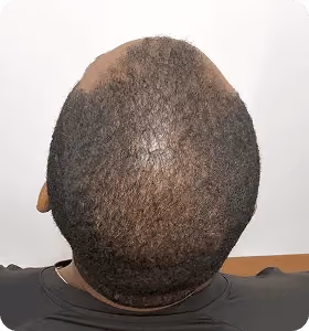 Vorher: Mann, 30 Jahre, Hinterkopf vor der regenerativen Haartherapie