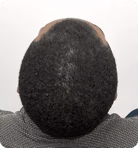 Nachher: Mann, 30 Jahre, Hinterkopf nach der regenerativen Haartherapie