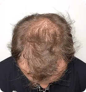 Vorher: Mann, 34 Jahre, Hinterkopf vor der regenerativen Haartherapie