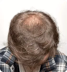 Nachher: Mann, 34 Jahre, Hinterkopf nach der regenerativen Haartherapie