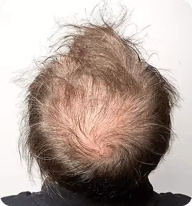 Vorher: Mann, 34 Jahre, Hinterkopf vor der regenerativen Haartherapie