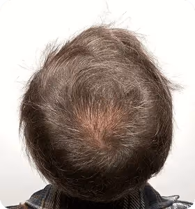 Nachher: Mann, 34 Jahre, Hinterkopf nach der regenerativen Haartherapie