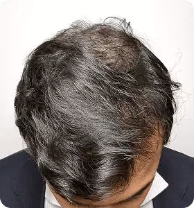 Vorher: Mann, 29 Jahre, Hinterkopf vor der regenerativen Haartherapie