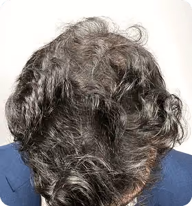 Nachher: Mann, 29 Jahre, Hinterkopf nach der regenerativen Haartherapie