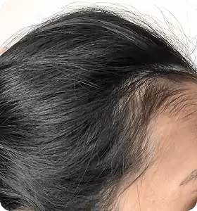 Nachher: Frau, 35 Jahre, Geheimratsecken nach der regenerativen Haartherapie