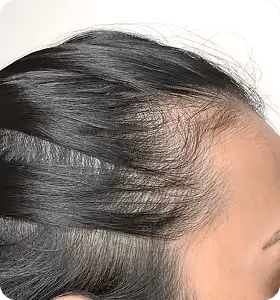 Vorher: Frau, 35 Jahre, Geheimratsecken vor der regenerativen Haartherapie