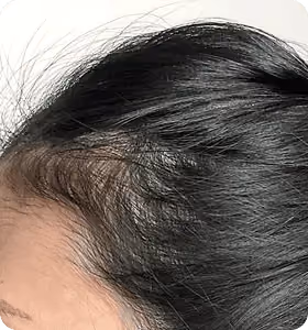 Nachher: Frau, 35 Jahre, Geheimratsecken nach der regenerativen Haartherapie