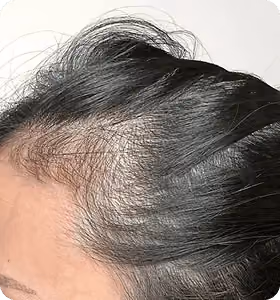 Vorher: Frau, 35 Jahre, Geheimratsecken vor der regenerativen Haartherapie
