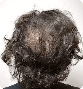 Vorher: Mann, 38 Jahre, Hinterkopf vor der regenerativen Haartherapie