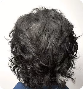 Nachher: Mann, 38 Jahre, Hinterkopf nach der regenerativen Haartherapie