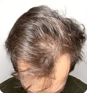 Vorher: Mann, 38 Jahre, Haarlinie vor der regenerativen Haartherapie