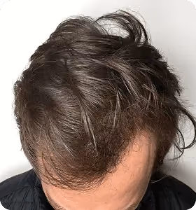 Nachher: Mann, 38 Jahre, Haarlinie nach der regenerativen Haartherapie