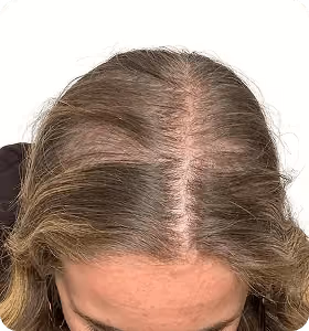 Vorher: Frau, 28 Jahre, Scheitel vor der regenerativen Haartherapie