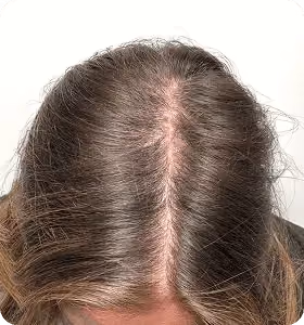 Nachher: Frau, 28 Jahre, Scheitel nach der regenerativen Haartherapie