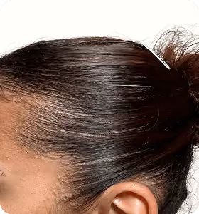 Vorher: Frau, 26 Jahre, Geheimratsecken vor der regenerativen Haartherapie