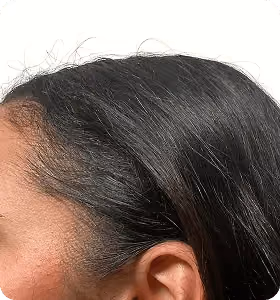 Nachher: Frau, 26 Jahre, Geheimratsecken nach der regenerativen Haartherapie