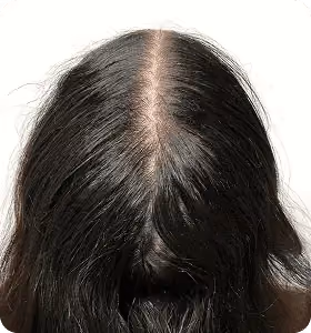 Nachher: Frau, 26 Jahre, Scheitel nach der regenerativen Haartherapie