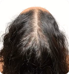 Vorher: Frau, 26 Jahre, Scheitel vor der regenerativen Haartherapie