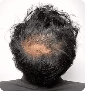 Vorher: Mann, 31 Jahre, Hinterkopf vor der regenerativen Haartherapie
