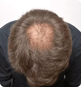 Vorher: Mann, 50 Jahre, Hinterkopf vor der regenerativen Haartherapie