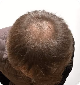 Nachher: Mann, 50 Jahre, Hinterkopf nach der regenerativen Haartherapie