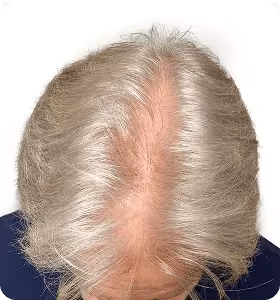 Vorher: Mann, 52 Jahre, Hinterkopf vor der regenerativen Haartherapie