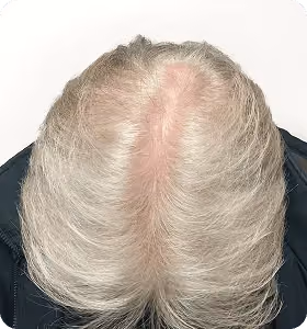 Nachher: Mann, 52 Jahre, Hinterkopf nach der regenerativen Haartherapie