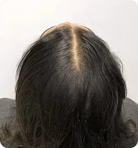 Nachher: Frau, 33 Jahre, Scheitel nach der regenerativen Haartherapie