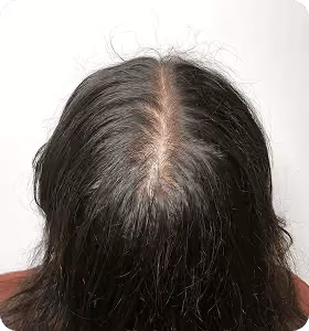 Vorher: Frau, 33 Jahre, Scheitel vor der regenerativen Haartherapie