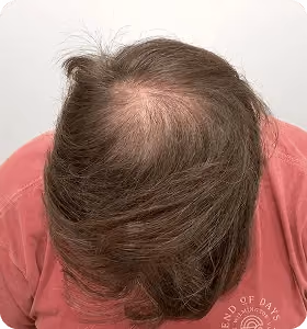 Vorher: Mann, 43 Jahre, Hinterkopf vor der regenerativen Haartherapie