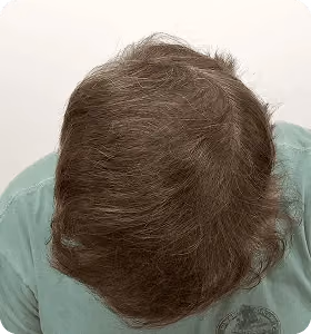 Nachher: Mann, 43 Jahre, Hinterkopf nach der regenerativen Haartherapie