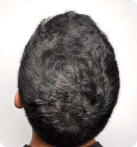 Nachher: Mann, 37 Jahre, Hinterkopf nach der regenerativen Haartherapie